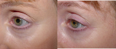 Affirm treatment of eye area wrinkles (crowsfeet) - This 49 year old woman had improvement of crowsfeet from a series of 4 Affirm laser treatments.&nbsp; Each treatment caused pinkness and slight swelling that lasted only a few hours.