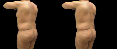 35-44 year old man treated with Body Jet - Patient had a previous liposuction surgery and was also concerned about the dimples from cellulite on his buttock. Treated with Vaser and BodyJet for HiDef lipo and Cellfina to treat the dimples on his buttock.