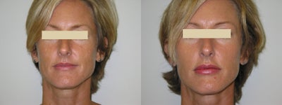 Advanta Lip Augmentation - 41 year old female before and after lip augmentation with advanta
