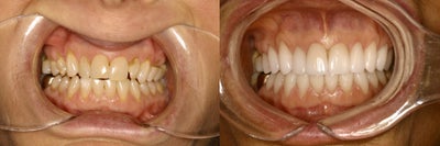 Gumline notches - Even after the bite was balanced, the notches on the teeth remained.&nbsp; Upper and lower porcelain restorations corrected all of the cosmetic concerns she had.