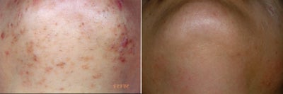 Chin folliculitis and LHR - 23 yo female with ingrown hairs and folliculitis treated with Lightsheer laser. 8 sessions over 1 year