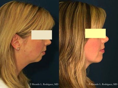Chin/Neck Liposuction  - Female patient in her&nbsp;mid-30's had liposuction to the chin and neck to achieve a more contoured line to her face.
