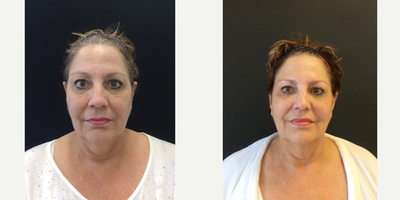 55-64 year old woman treated with Kybella - One treatment of the sub mental fat (double chin), one month after treatment.