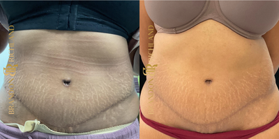35-44 year old woman treated with Morpheus8 - Patient had 2 treatments of Morpheus 8 to her abdomen to reduce the appearance of skin irregularities and stretch marks.