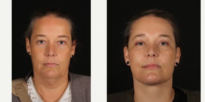 45-54 year old woman treated with Facelift, Neck Lift, Deep Plane Facelift, Eyelid Surgery, Facial Fat Transfer, Double Eyelid S - We had our third & final visit with one of our favorite #kansascity patients after her facelift, deep neck lift, upper and lower #blepharoplasty and fat grafting. I really spent a lot of time trying to get the neck contour correct and I think she's healing beautifully. She's also got an awesome attitude and our team loves her. Thanks to her for letting us share her #facelift journey!