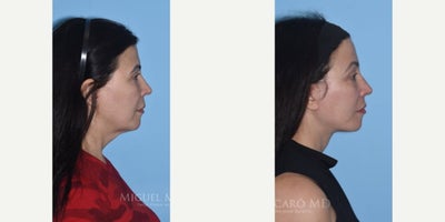 Woman treated with Facelift - Woman treated with Facelift, endoscopic Brow Lift, and Lip Lift