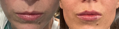 Woman treated with Lip Fillers - Woman treated with Lip Fillers.