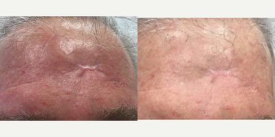 65-74 year old man treated with Fraxel Repair, Scar Removal - 67 YO after one Fraxel Repair (Fraxel CO2 , Fraxel Carbon Dioxide) laser for raised scar.
