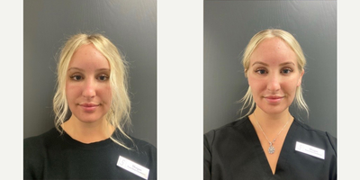 Woman treated with Fraxel Laser - Woman treated with Fraxel Laser