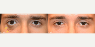 Man treated with Skin Rejuvenation - This 21-year-old male presented with a scar on the right lower lid that was causing disfigurement and right lower eyelid retraction. He had 2 sessions of CO2 laser resurfacing to help fade the scar and improve the quality and texture of the skin.