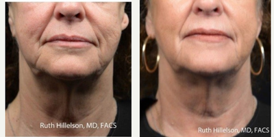 55-64 year old woman treated with Thermage - Thermage on the mid-face and neck area. Photos taken before Thermage and 4 months after Thermage.