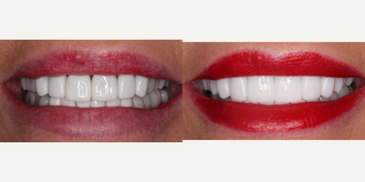 55-64 year old woman treated with Dental Implants - While healing from anterior extractions in the interim before dental implants can be placed, this patient is wearing a bridge until implants can be restored. This fixed option is more aesthetic and less maintenance than the removable alternative.