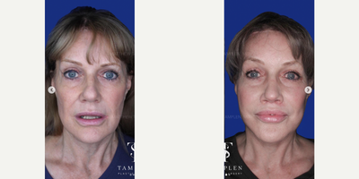 Woman treated with Deep Plane Facelift, Brow Lift, Lip Lift, Rhinoplasty - This lovely patient had a previous facelift but was bothered by persistent jowls and neck bands.She was also unhappy with the appearance of her nose and the scarring from her previous facelift.She now absolutely loves her new look which was achieved through 1 single transformative procedure that included my extended deep plane facelift, lateral brow lift, lip lift, and open rhinoplasty.