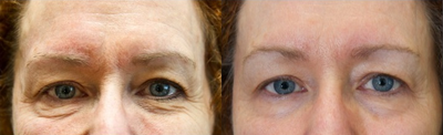 Exilis Elite- Female Treated for Under Eye Bags - Treated with a package of four Exilis Elite treatments.