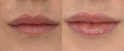 25-34 year old woman treated with Lip Augmentation - Our patient Sofie wanted to even out her lips. The lower lip was less voluminous than the top lip. Sofies lip goal was to make the lower lip more evenly balanced and pronounced. One syringe of HA Filler was used to achieve this beautiful symmetry!