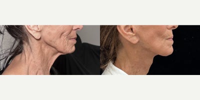 76 year old woman treated with Deep Plane Facelift, Neck Lift, Facial Fat Transfer, CO2 Laser - 76 year old woman treated with Deep Plane Facelift, Neck Lift, Facial Fat Transfer, CO2 Laser