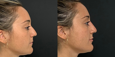 Woman treated with Nonsurgical Nose Job - Woman treated with Nonsurgical Nose Job