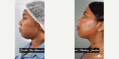 25-34 year old woman treated with Aqualyx, Kybella, Botox - i did double chin removal and marking jawline.