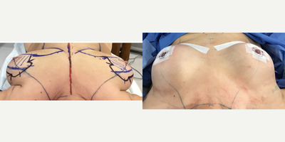 55-64 year old woman treated with Breast Reduction - Immediate postop of Breast Reduction