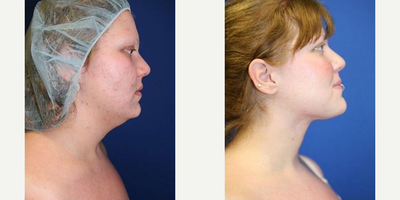 Woman treated with Chin Liposuction - Woman treated with Chin Liposuction