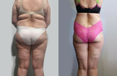 Woman treated with Cryoskin - Woman treated with Cryoskin