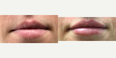 25-34 year old woman treated with Restylane - Restylane filler injected in the upper and lower lips of this young woman.