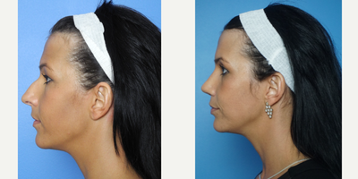 25-34 year old woman treated with Rhinoplasty - de-projection and humor reduction