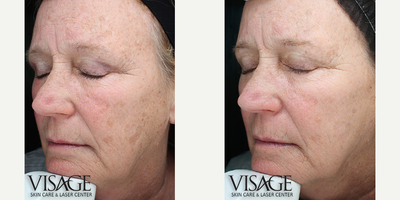 65-74 year old woman treated with Halo Laser - Combo Halo Laser + Broadband Light Laser Therapy Treatment with Heather Davis, LE, Assistant Laser Practitioner & Licensed Esthetician, Visage Skin Care & Laser Center, a division of Robinson Facial Plastic Surgery, 1 Treatment