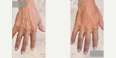 Woman treated with Renuva - Woman treated with Restylane.