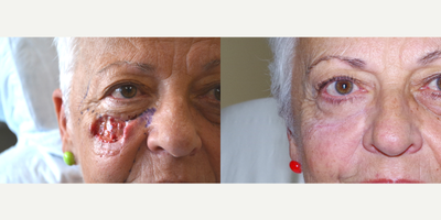 65-74 year old woman treated with Facial Reconstructive Surgery - 73 year old female received reconstructive surgery for MOHs Repair; photos depict the patient's results 1 year post-op.