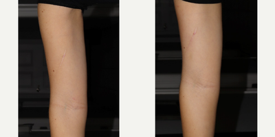 18-24 year old woman treated with Opus Plasma - Scar on left arm