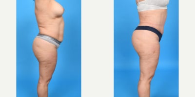 35-44 year old woman treated with Abdominal Etching, Diastasis Recti Repair, Drainless Tummy Tuck, Liposculpture, Liposuction, M - Before and after corset tummy tuck with bikini incision, VASER ultrasound assisted liposuction, 360