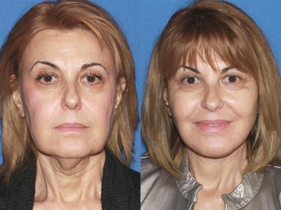 SMAS Facelift - This patient was concerned with significant skin laxity, jowls and sagging cheeks. Face and neck lift was performed.