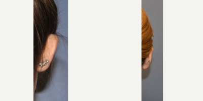 Woman treated with Ear Surgery - Woman treated with Ear Surgery.