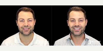 35-44 year old man treated with Hyaluronidase - The patient is a 36-year-old male who had concerns about the appearance of his midface after previous filler treatment. Dr. Chiang used 4 vials of Hylenex to dissolve filler under the eyes, the nasolabial folds, and around the mouth on the patients right side to address these concerns. The after results are 1 year post-treatment.