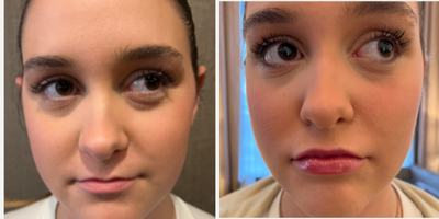 18-24 year old woman treated with Lip Fillers, Restylane Silk - First time lip filler in a young woman with very thin lips.