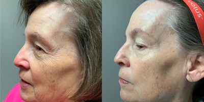 65-74 year old woman treated with Neo Laser - Aerolase Neo Laser for skin rejuvenation