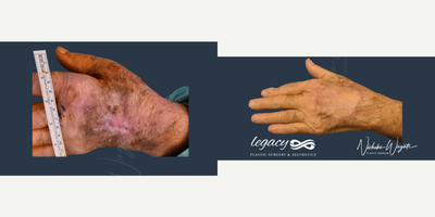 65-74 year old man treated with Hand Reconstructive Surgery - Mohs Hand