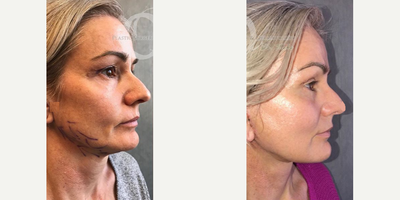 Woman treated with Neck Lift - Woman treated with Neck Lift
