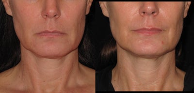 Ultherapy treatment for lower face - Ultherapy  on lower face jowls, 1 treatment.&nbsp;