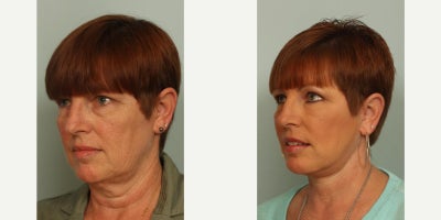45-54 year old woman treated with Neck Lift - Glidelift, neck lift and fat transfer to face; 6 months post-op