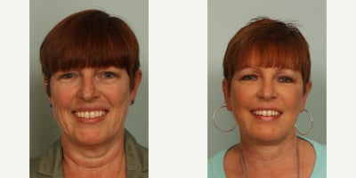 45-54 year old woman treated with Facial Fat Transfer - Glidelift, neck lift and fat transfer to face; 6 months post-op