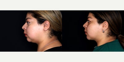 23 year old woman treated with Liposuction, PrecisionTx, Facial Fat Transfer to chin - 23 year old female treated with liposuction to face and submental neck (Precision tx) and fat transfer to the chin. Photos depict before and 3 months after surgery
