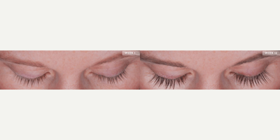 Woman treated with Latisse - Woman treated with Latisse
