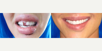 Woman treated with Full Mouth Reconstruction, Smile Makeover - Smile Makeover miracle! After a freak accident left this patient with multiple facial injuries including 2 broken front teeth, she came in see Dr. Maddahi and in just 2 visits he was able to reconstruct her smile!