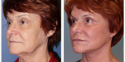 Woman treated with SMAS Facelift - Woman treated with SMAS Facelift, Neck Lift, and Facial Fat Transfer to rejuvenate cheeks, jowls, and neck.