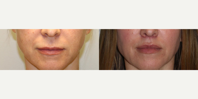 Woman treated with Lip Surgery - Woman treated with Lip Surgery through Lip Lift