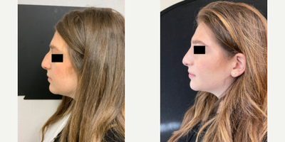 Woman treated with Rhinoplasty - Woman treated with Rhinoplasty.