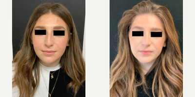 Woman treated with Rhinoplasty - Woman treated with Rhinoplasty.