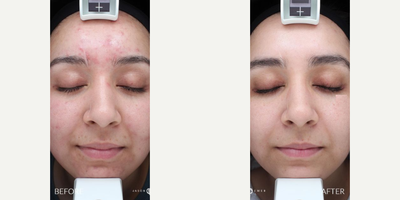 Woman treated with Accutane - Woman treated with Accutane